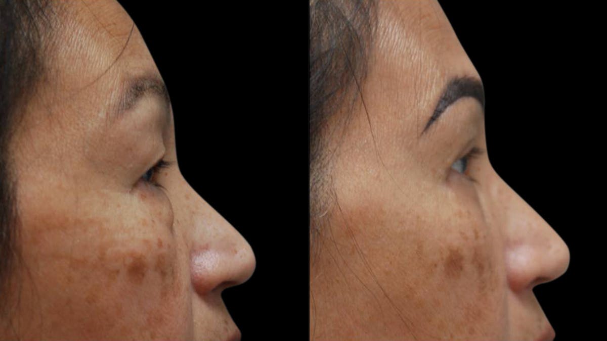 Asian Eyelid Surgery Before & After Gallery - Patient 126200 - Image 10