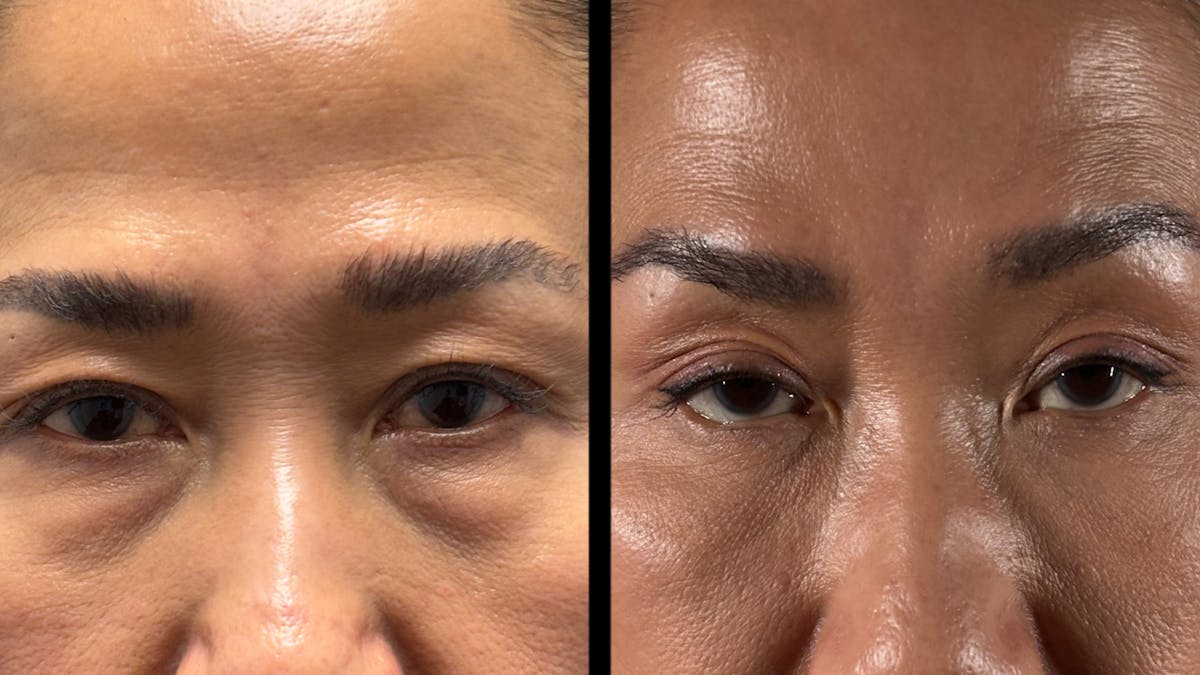Asian Eyelid Surgery Before & After Gallery - Patient 138322 - Image 1