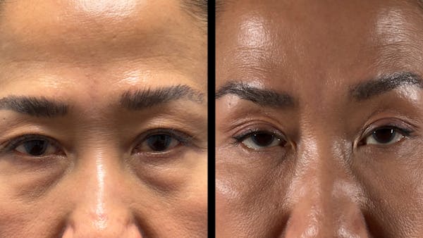 Asian Eyelid Surgery Before & After Gallery - Patient 138322 - Image 1