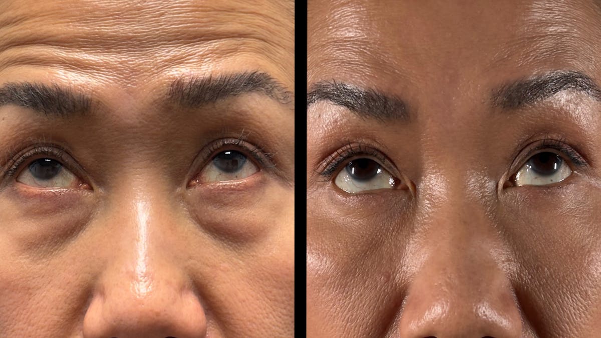 Asian Eyelid Surgery Before & After Gallery - Patient 138322 - Image 2