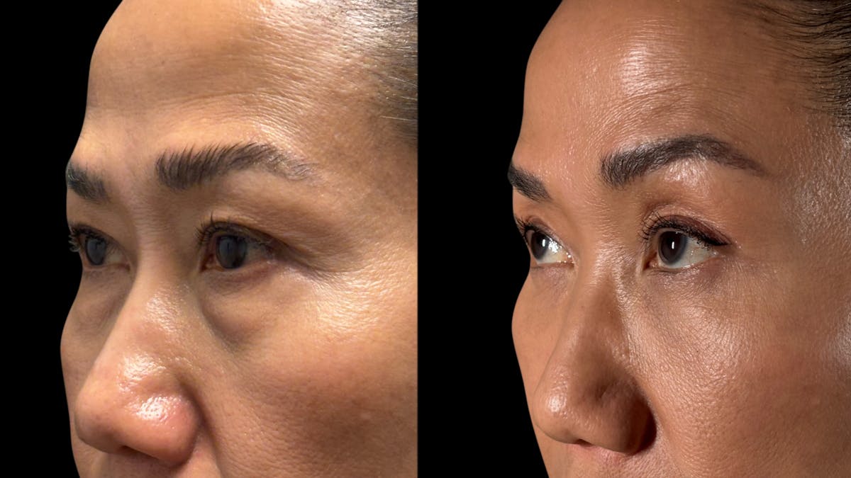 Asian Eyelid Surgery Before & After Gallery - Patient 138322 - Image 3