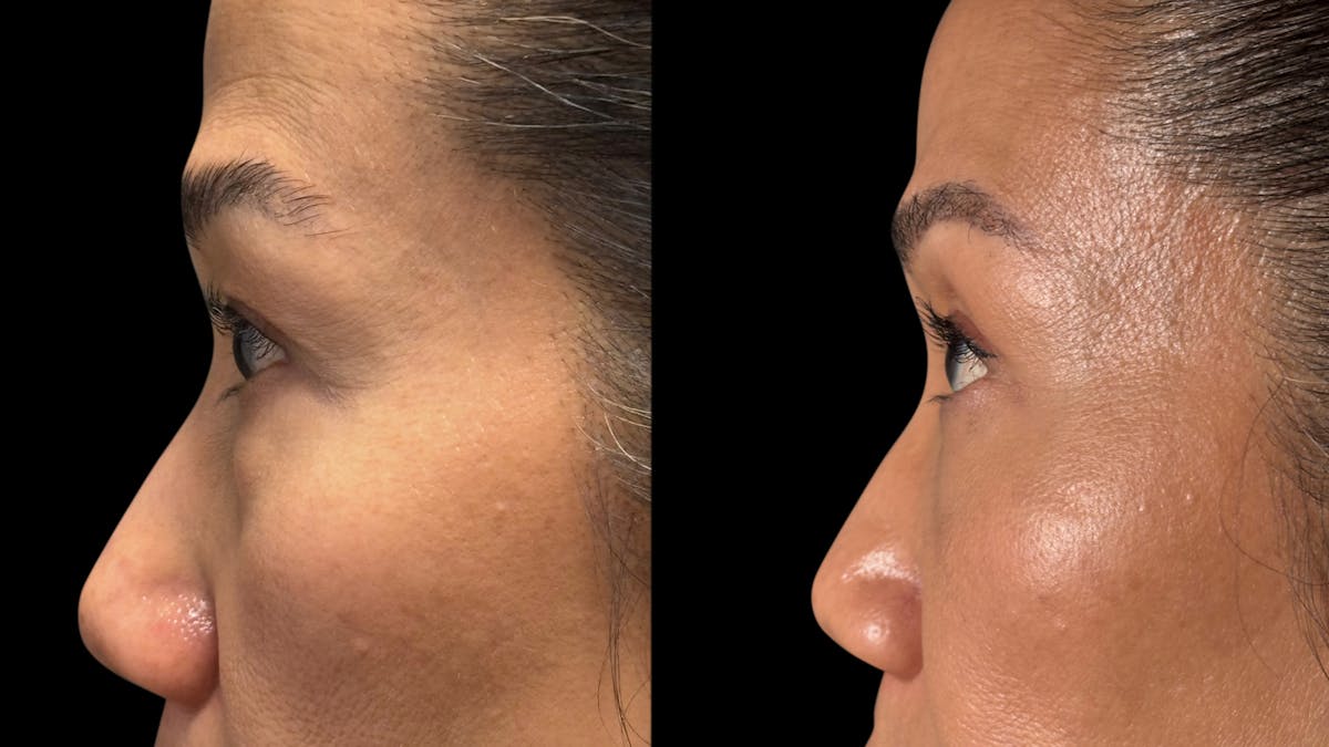 Asian Eyelid Surgery Before & After Gallery - Patient 138322 - Image 4