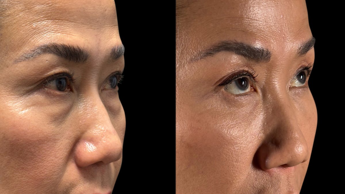 Asian Eyelid Surgery Before & After Gallery - Patient 138322 - Image 5