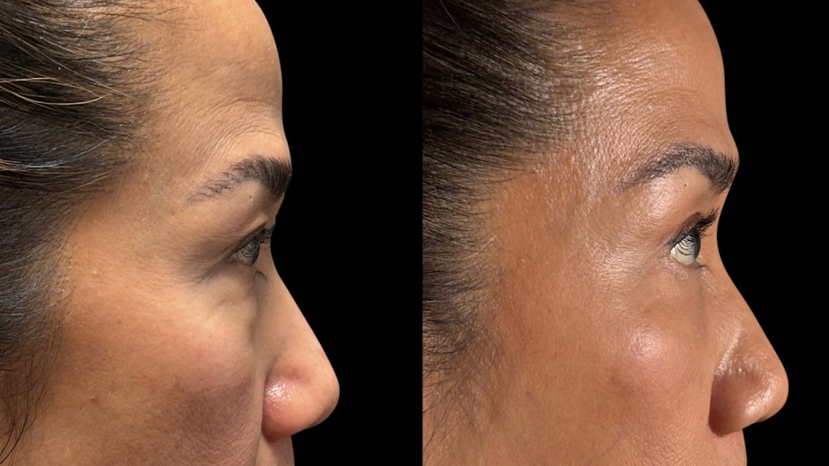 Asian Eyelid Surgery Before & After Gallery - Patient 138322 - Image 6