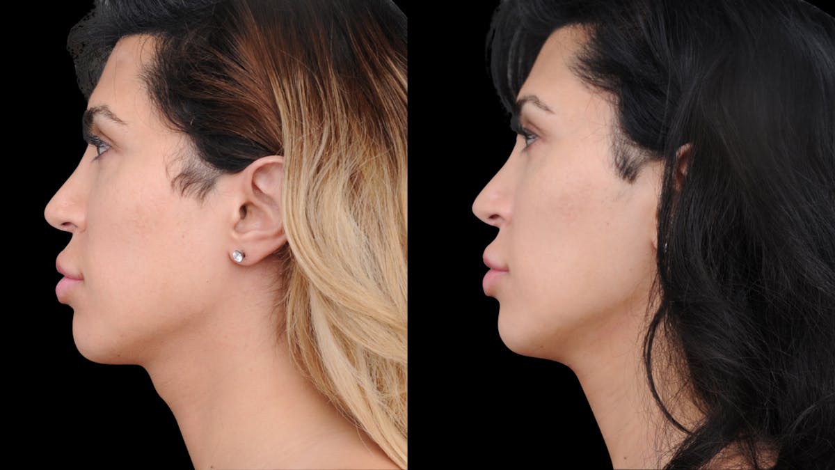 Brow Lift Before & After Gallery - Patient 182747 - Image 2