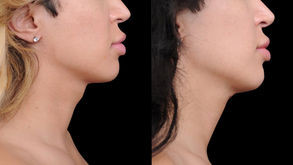 Brow Lift Before & After Gallery - Patient 182747 - Image 4