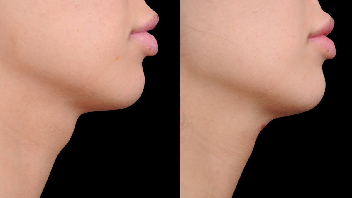 Brow Lift Before & After Gallery - Patient 182747 - Image 5