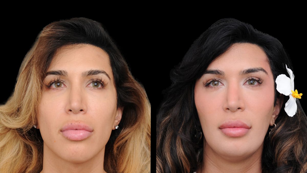 Brow Lift Before & After Gallery - Patient 182747 - Image 1