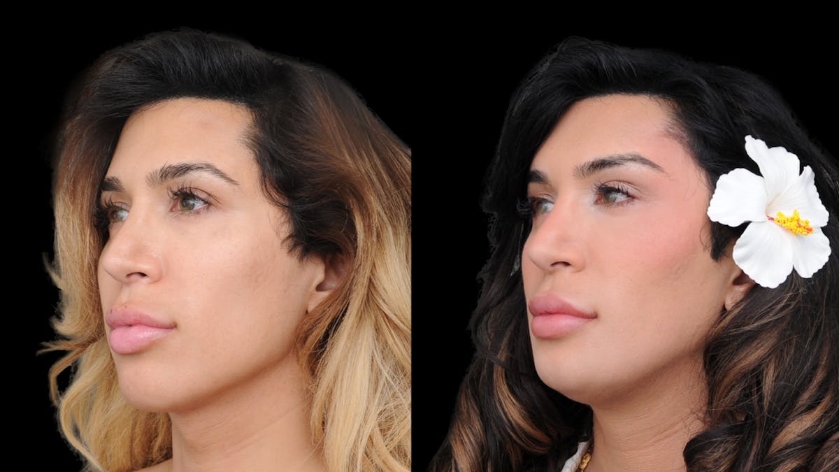 Brow Lift Before & After Gallery - Patient 182747 - Image 6
