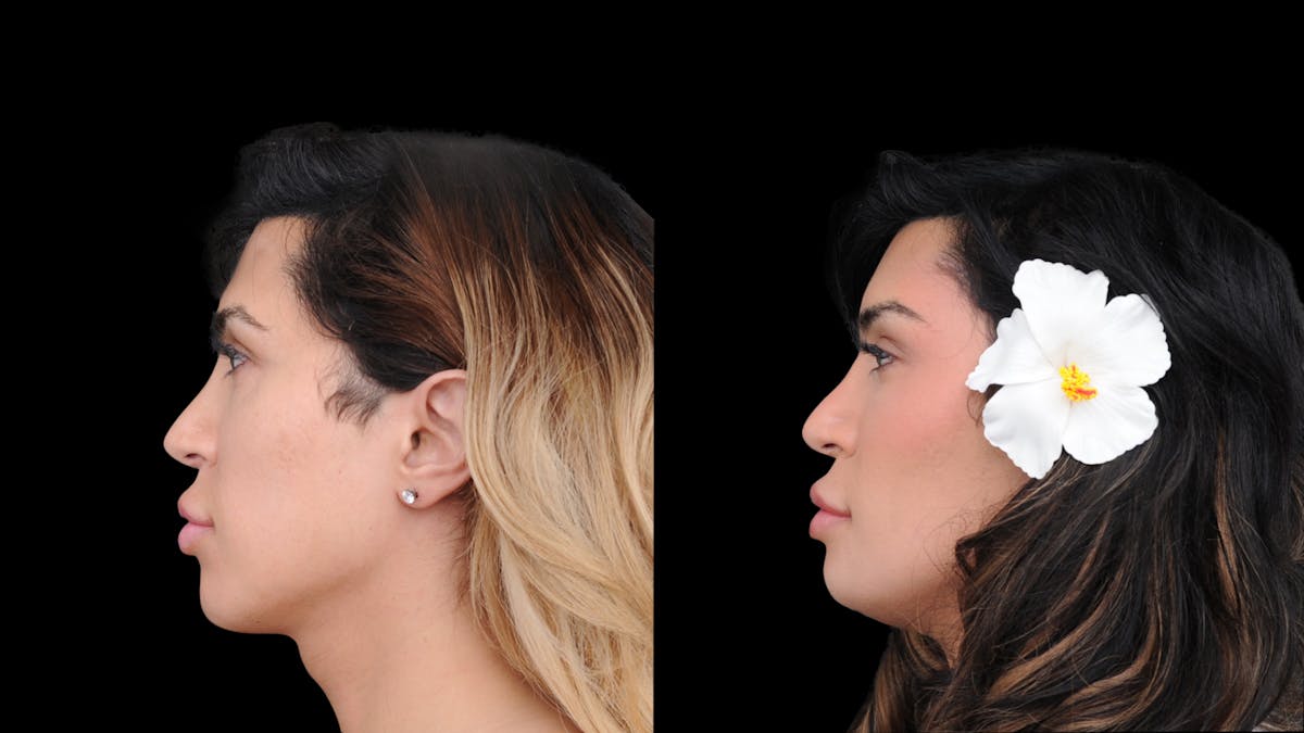 Brow Lift Before & After Gallery - Patient 182747 - Image 7