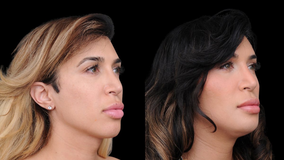 Brow Lift Before & After Gallery - Patient 182747 - Image 8