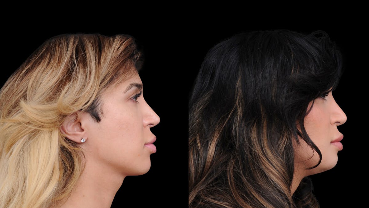 Brow Lift Before & After Gallery - Patient 182747 - Image 9