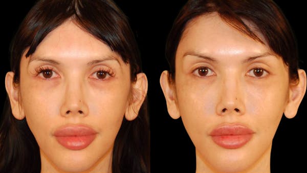 Brow Lift Before & After Gallery - Patient 188204 - Image 1
