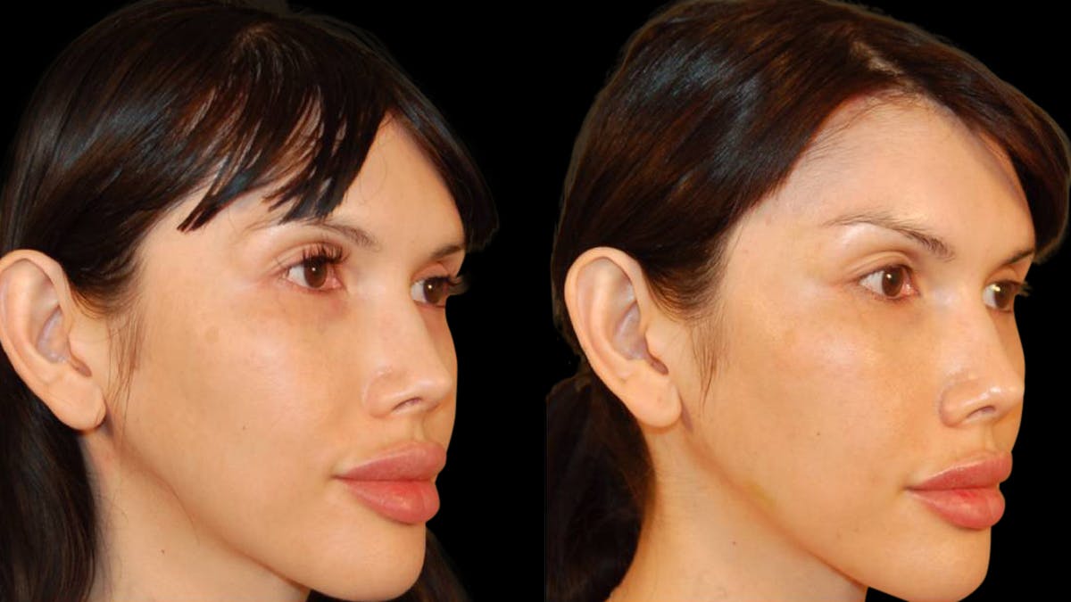 Brow Lift Before & After Gallery - Patient 188204 - Image 2