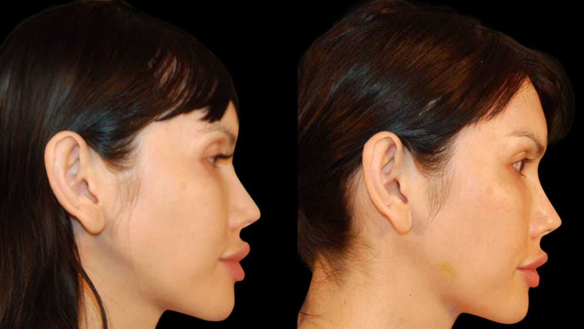 Brow Lift Before & After Gallery - Patient 188204 - Image 3