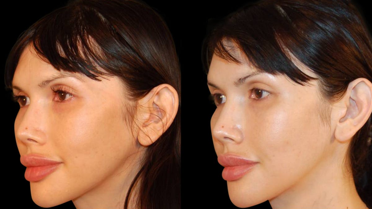 Brow Lift Before & After Gallery - Patient 188204 - Image 4