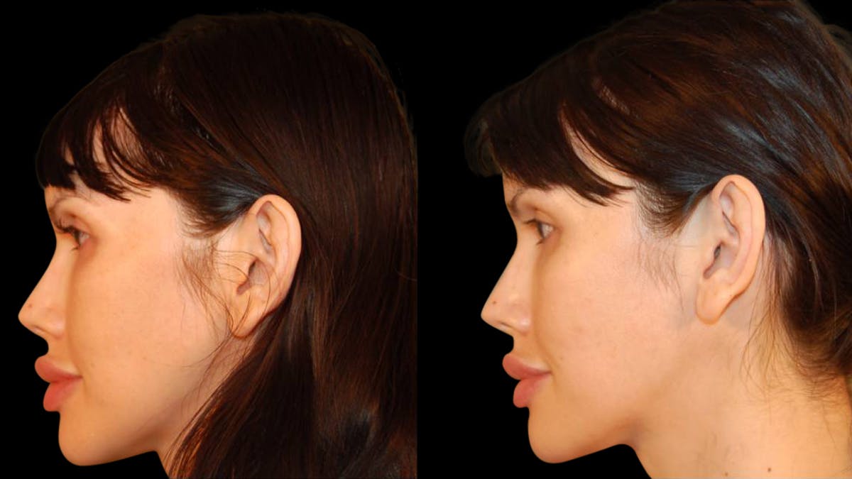 Brow Lift Before & After Gallery - Patient 188204 - Image 5