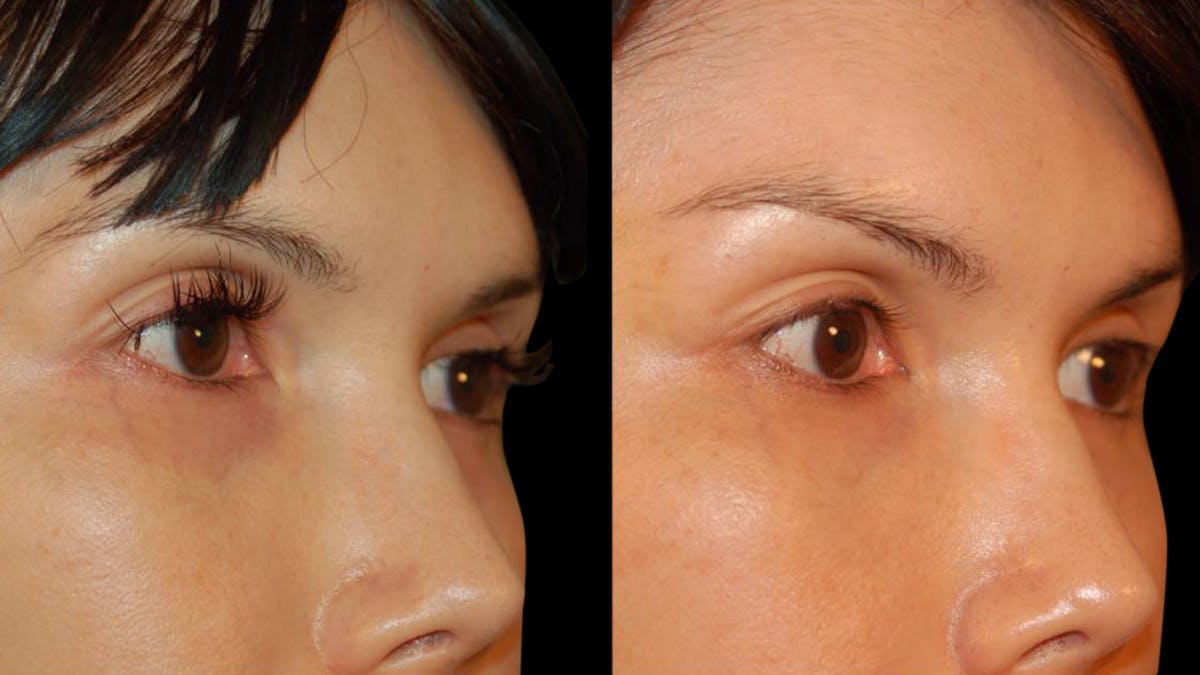 Brow Lift Before & After Gallery - Patient 188204 - Image 6