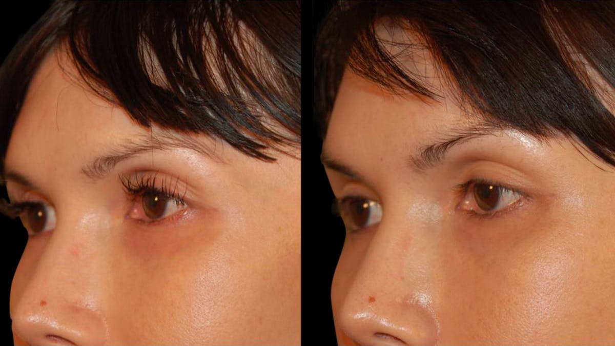 Brow Lift Before & After Gallery - Patient 188204 - Image 7