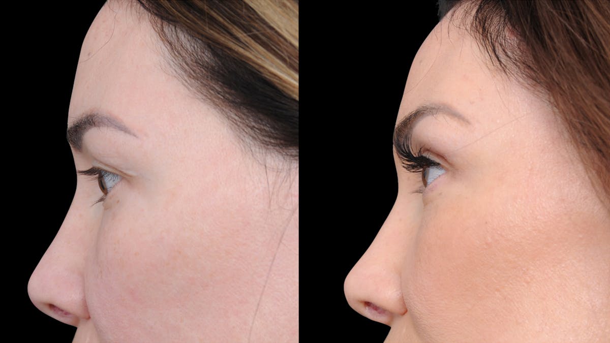 Brow Lift Before & After Gallery - Patient 786490 - Image 2