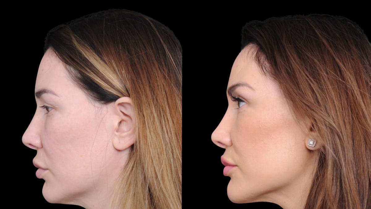 Brow Lift Before & After Gallery - Patient 786490 - Image 3