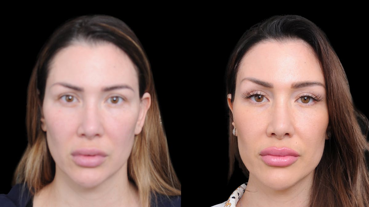 Brow Lift Before & After Gallery - Patient 786490 - Image 1
