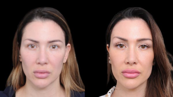 Brow Lift Before & After Gallery - Patient 786490 - Image 1
