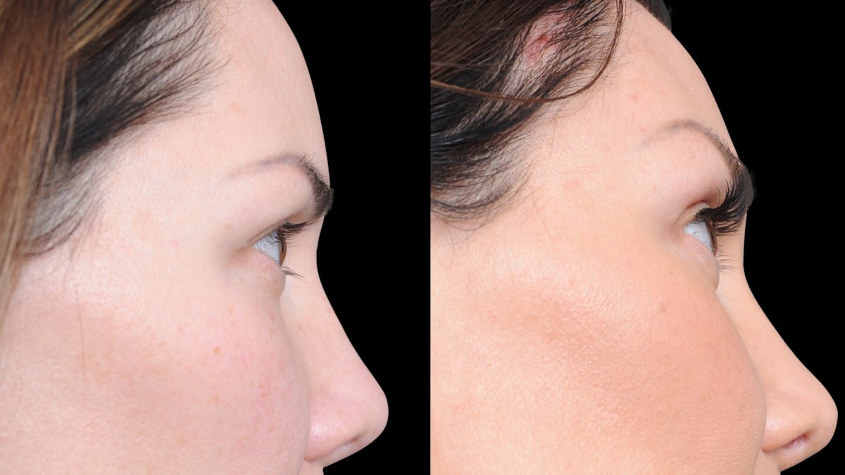 Brow Lift Before & After Gallery - Patient 786490 - Image 4