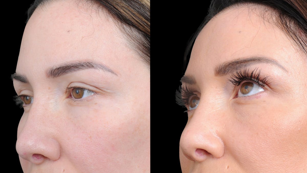 Brow Lift Before & After Gallery - Patient 786490 - Image 5
