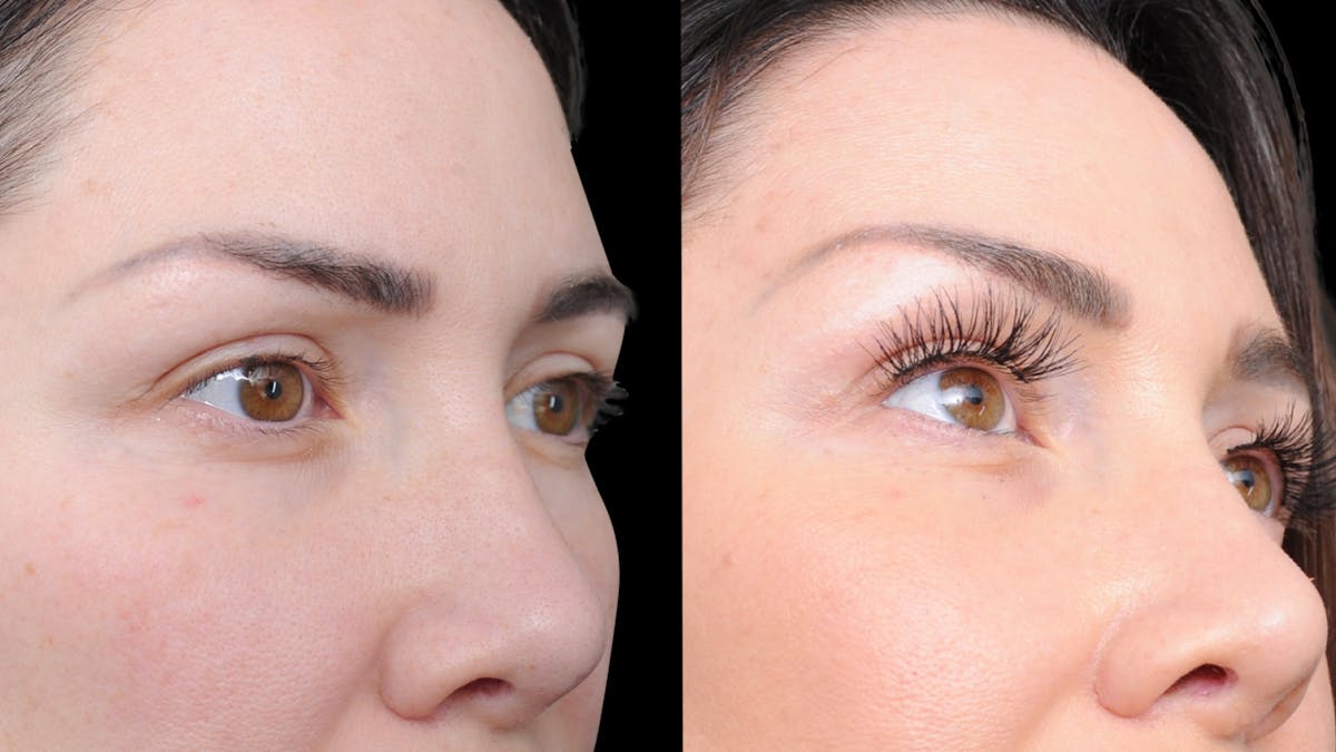 Brow Lift Before & After Gallery - Patient 786490 - Image 6