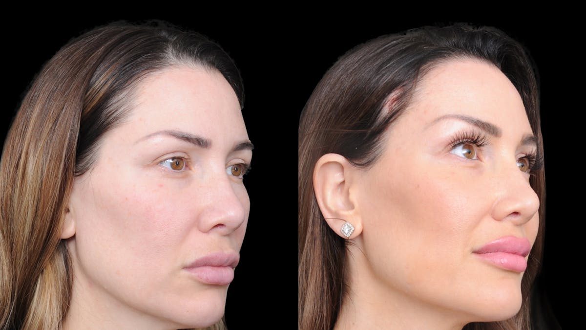 Brow Lift Before & After Gallery - Patient 786490 - Image 7