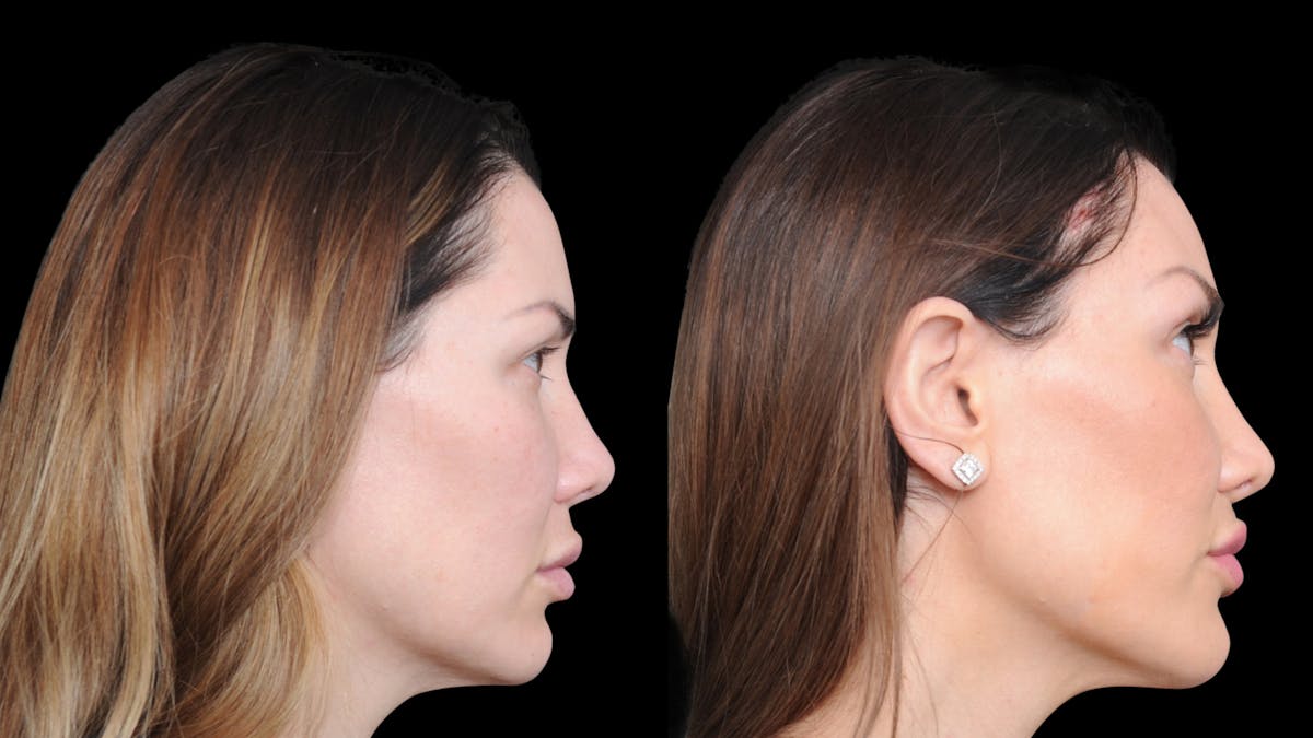 Brow Lift Before & After Gallery - Patient 786490 - Image 8