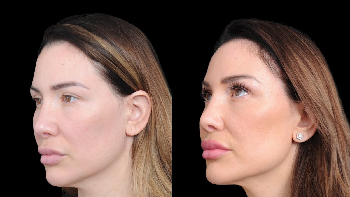 Brow Lift Before & After Gallery - Patient 786490 - Image 9