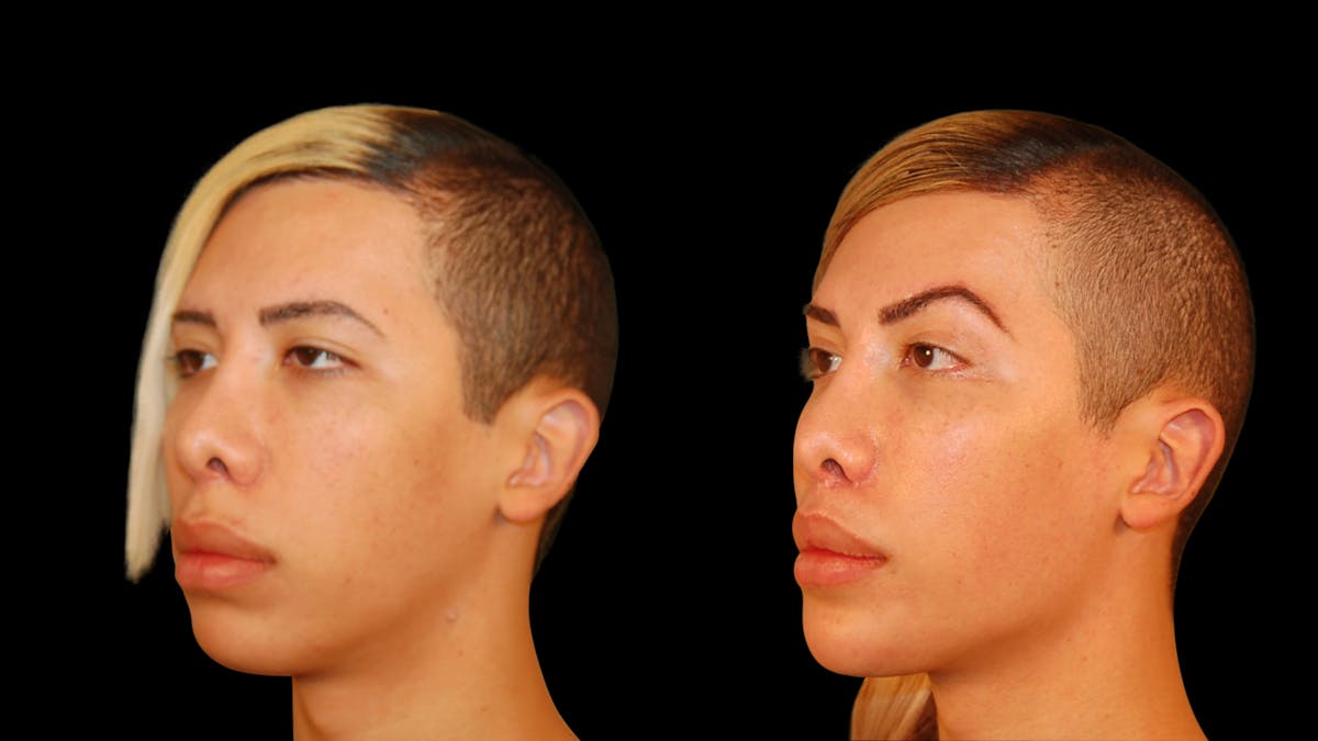 Brow Lift Before & After Gallery - Patient 896207 - Image 2