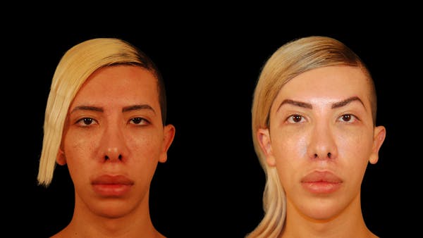 Brow Lift Before & After Gallery - Patient 896207 - Image 1