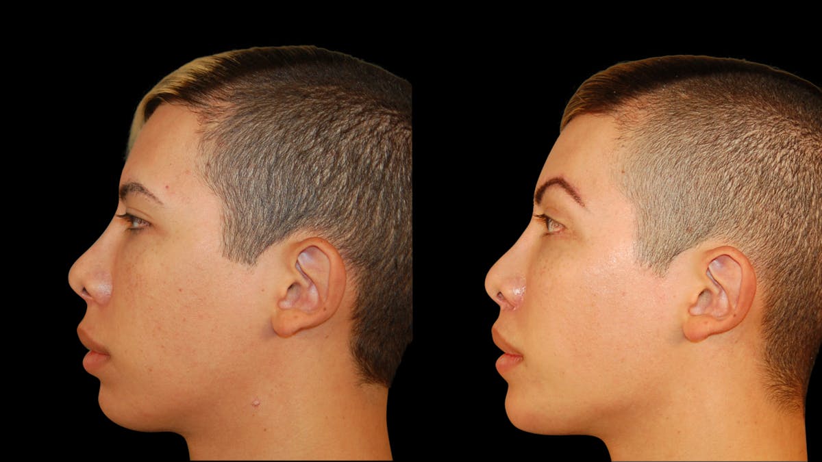 Brow Lift Before & After Gallery - Patient 896207 - Image 3