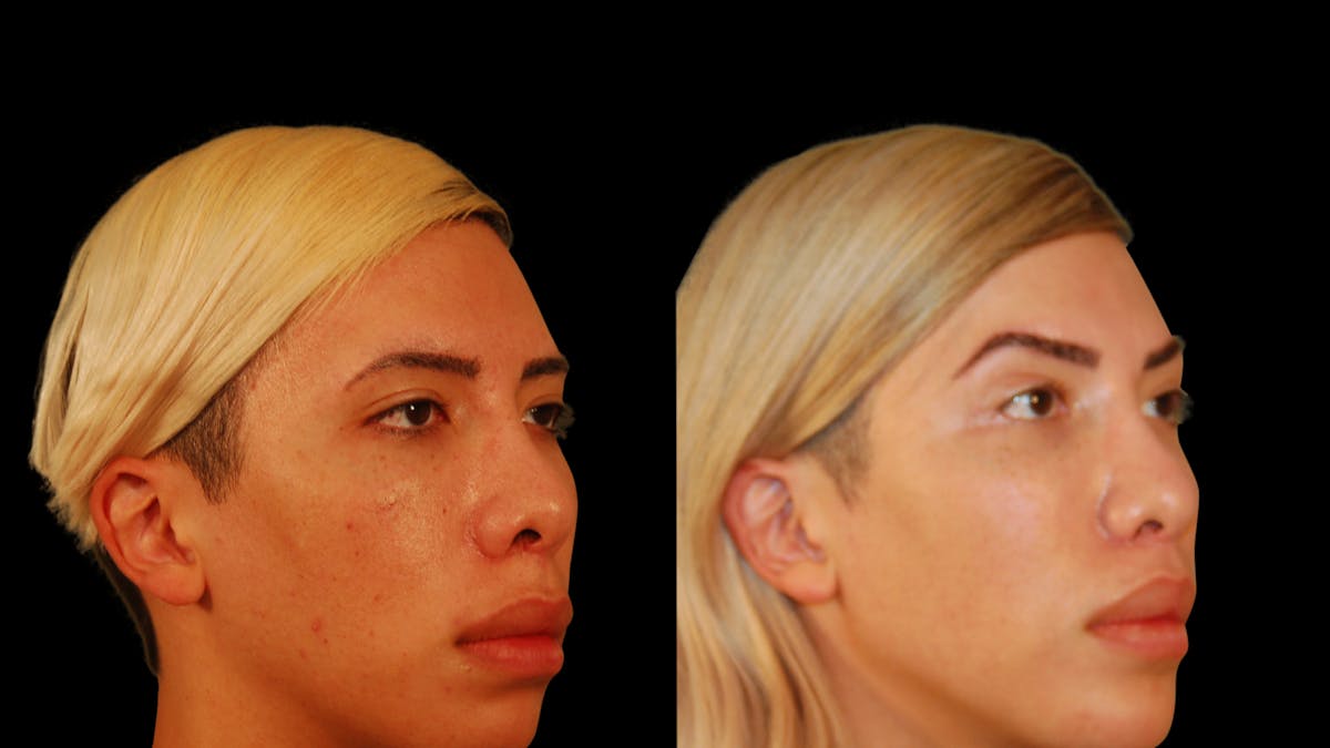 Brow Lift Before & After Gallery - Patient 896207 - Image 4