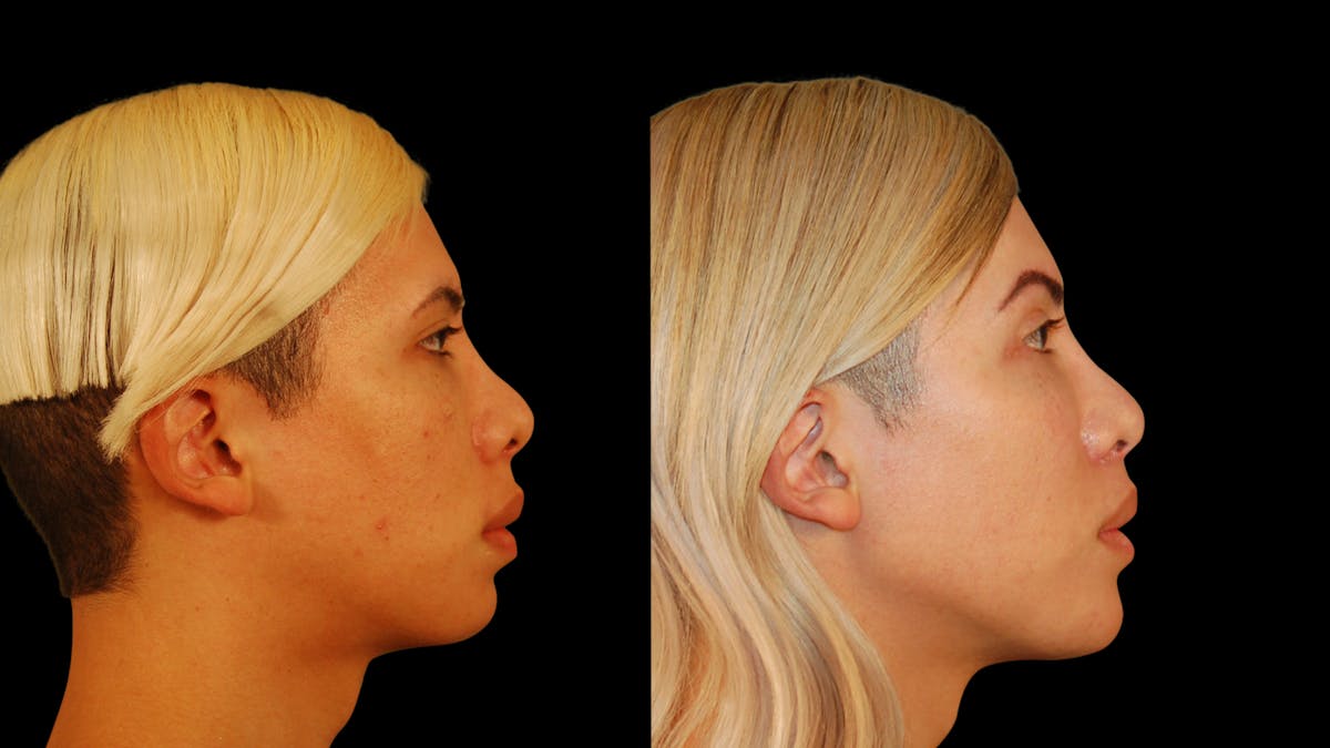 Brow Lift Before & After Gallery - Patient 896207 - Image 5