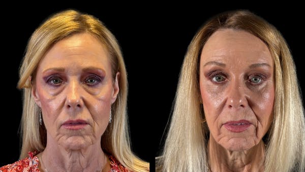 Brow Lift Before & After Gallery - Patient 209420 - Image 1
