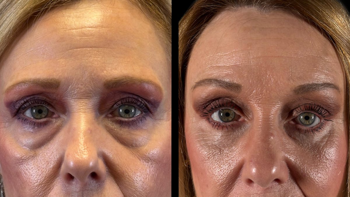Brow Lift Before & After Gallery - Patient 209420 - Image 2