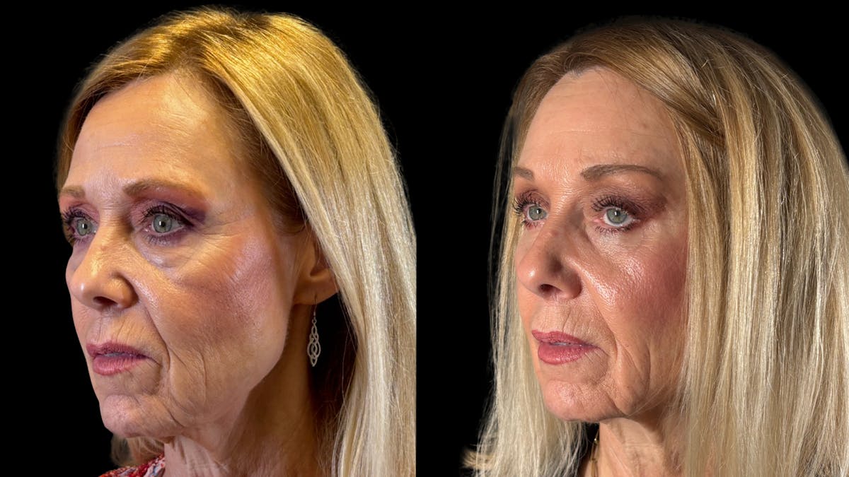 Brow Lift Before & After Gallery - Patient 209420 - Image 3