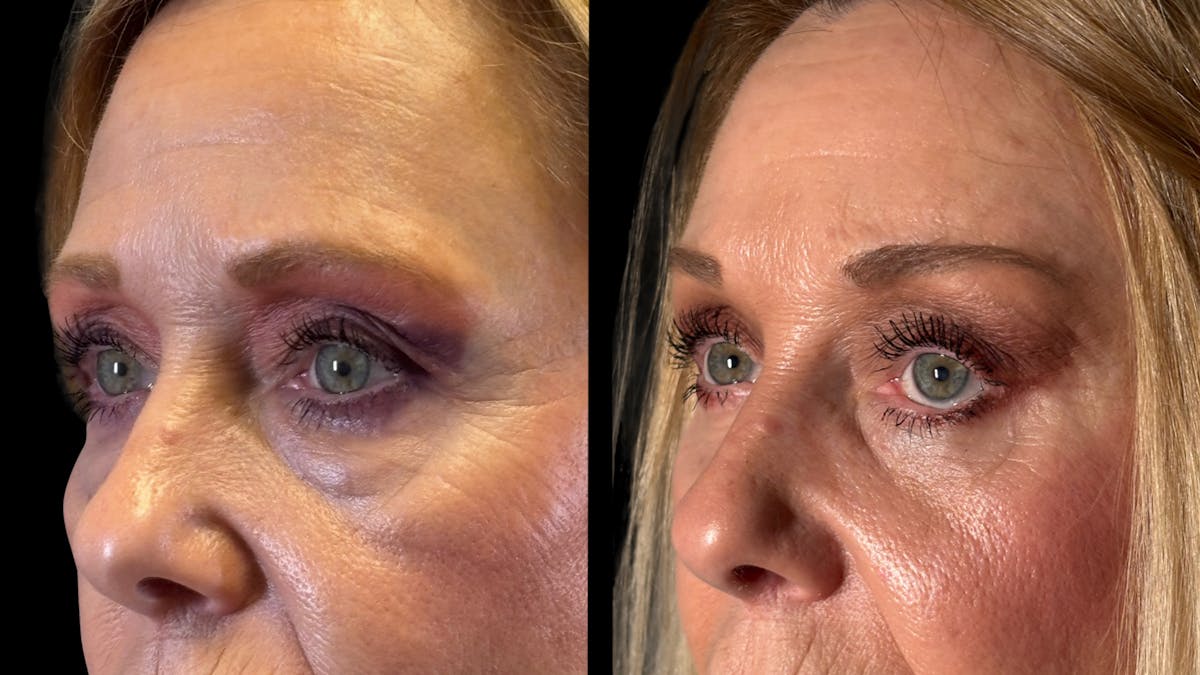 Brow Lift Before & After Gallery - Patient 209420 - Image 4