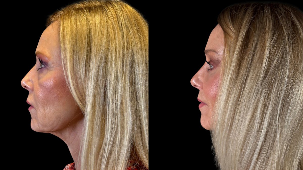 Brow Lift Before & After Gallery - Patient 209420 - Image 5