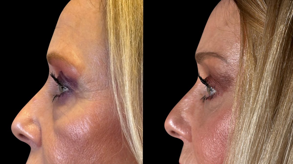 Brow Lift Before & After Gallery - Patient 209420 - Image 6