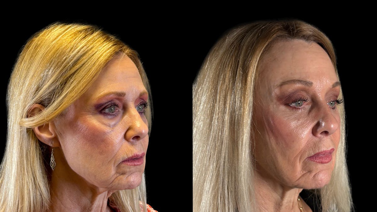 Brow Lift Before & After Gallery - Patient 209420 - Image 7
