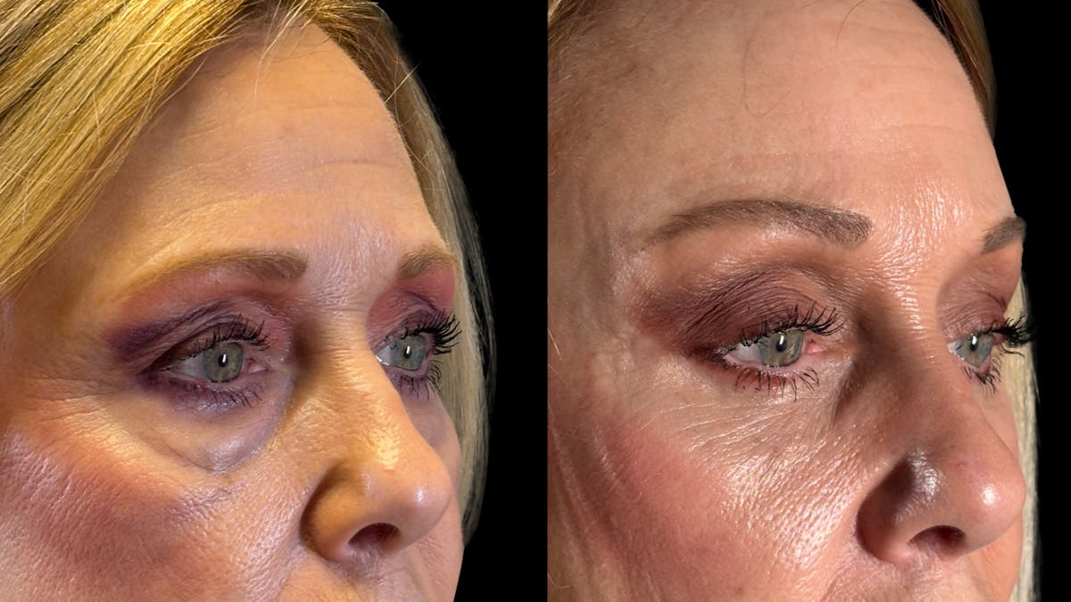 Brow Lift Before & After Gallery - Patient 209420 - Image 8