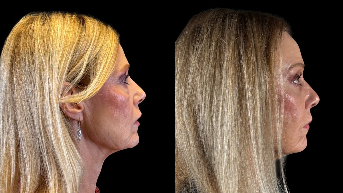 Brow Lift Before & After Gallery - Patient 209420 - Image 9