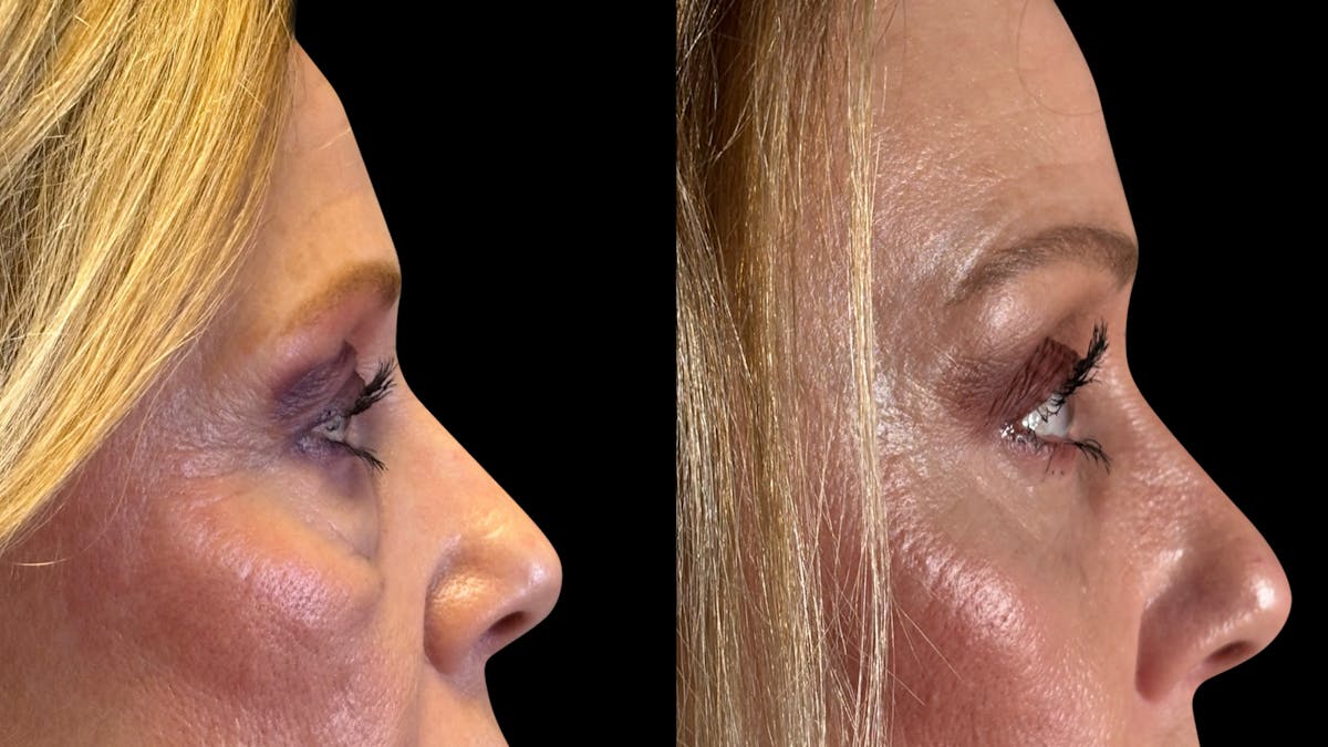 Brow Lift Before & After Gallery - Patient 209420 - Image 10