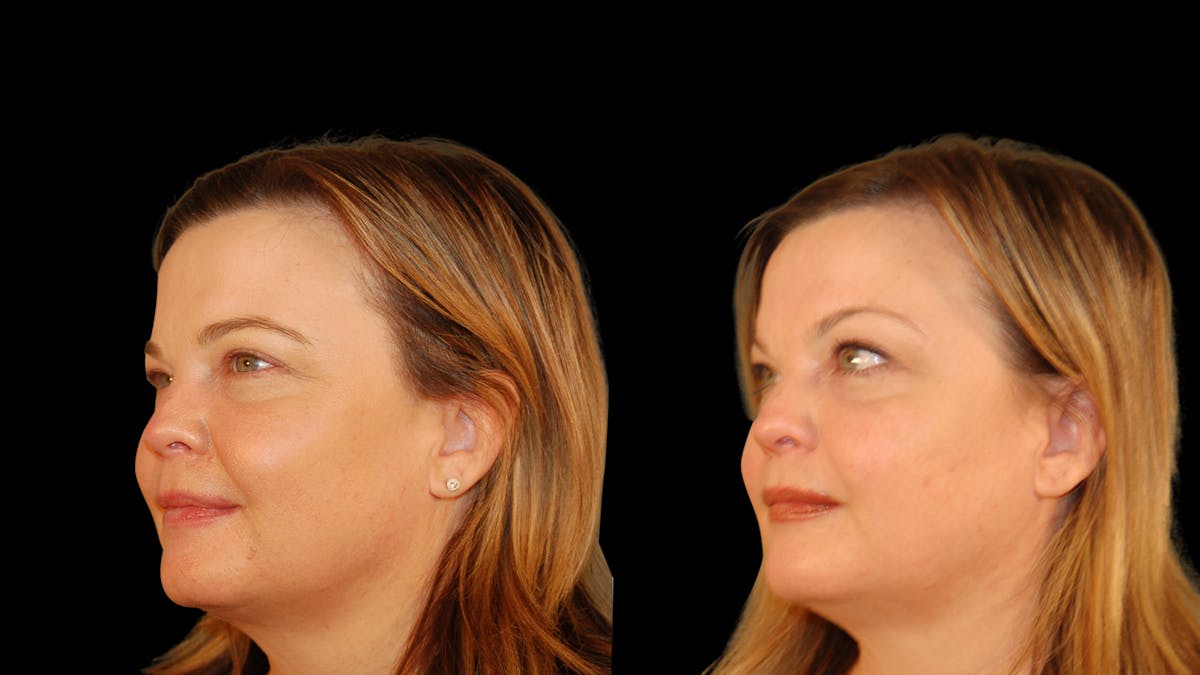 Brow Lift Before & After Gallery - Patient 395482 - Image 2