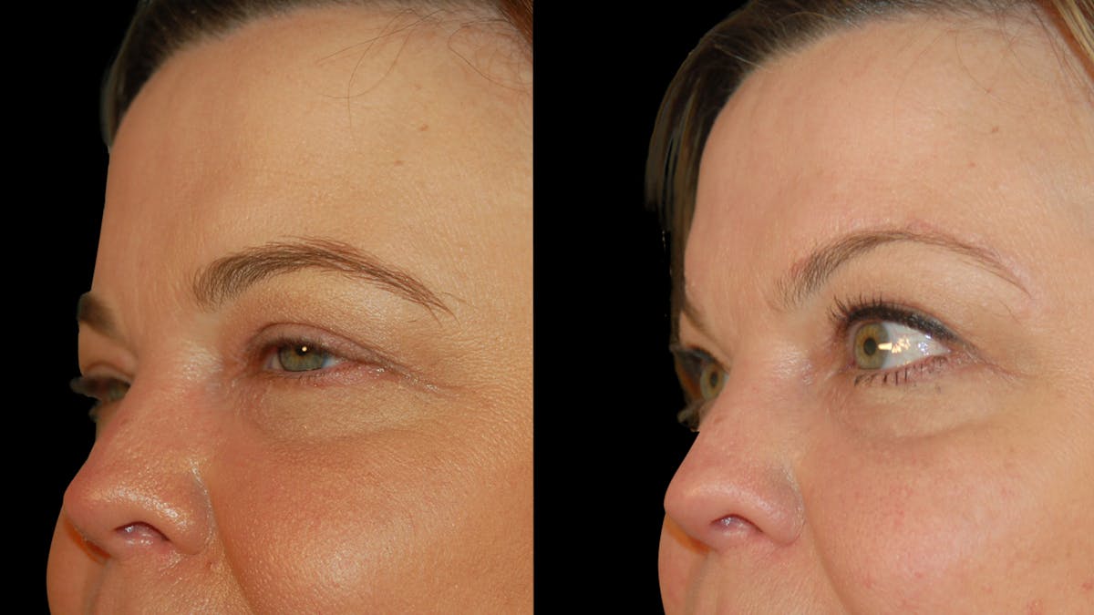 Brow Lift Before & After Gallery - Patient 395482 - Image 7